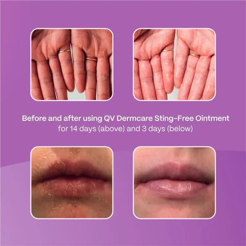 QV Dermcare Sting-Free Ointment - 100g Tube